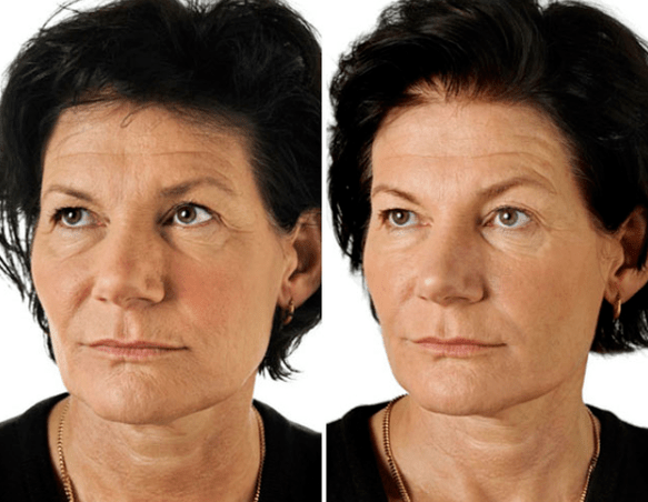 Das Ergebnis der fraktionalen Verjüngung des Gesichts