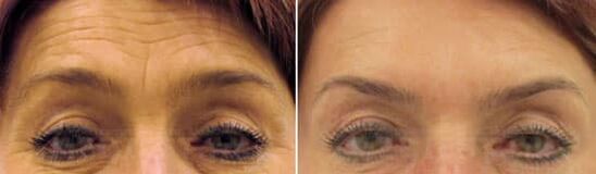 Feldverjüngung der Stirn