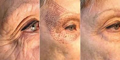 Fotos vor und nach der Plasma-Hautverjüngung